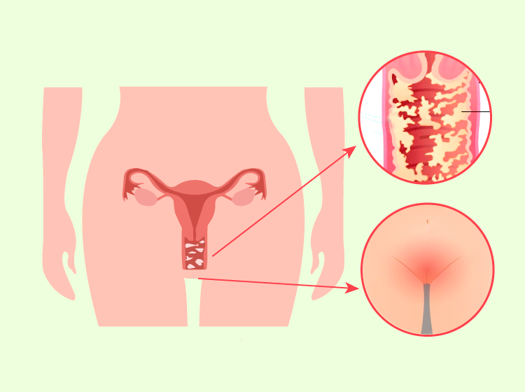 Recurrent Candidiasis